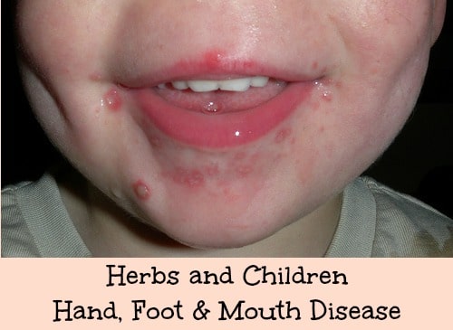 Hand, Foot & Mouth Disease | Features | CDC