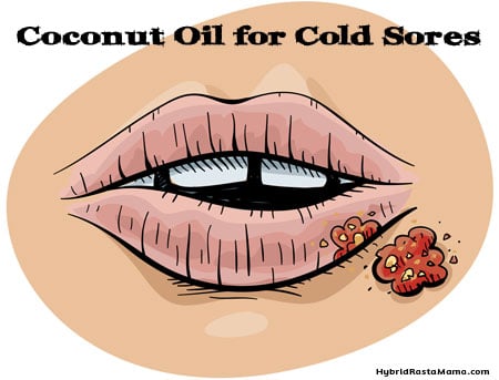 Coconut Oil For Cold Sores + Other Home Remedies
