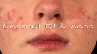 Did you know that you can use coconut oil for acne prevention and treatment? Learn how this powerful oil will kiss blemishes goodbye for good from HybridRastaMama.com.