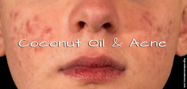 Coconut Oil For Acne