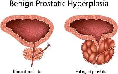 Coconut Oil and Men’s Health Issues – Enlarged Prostate (Benign Prostatic Hyperplasia)