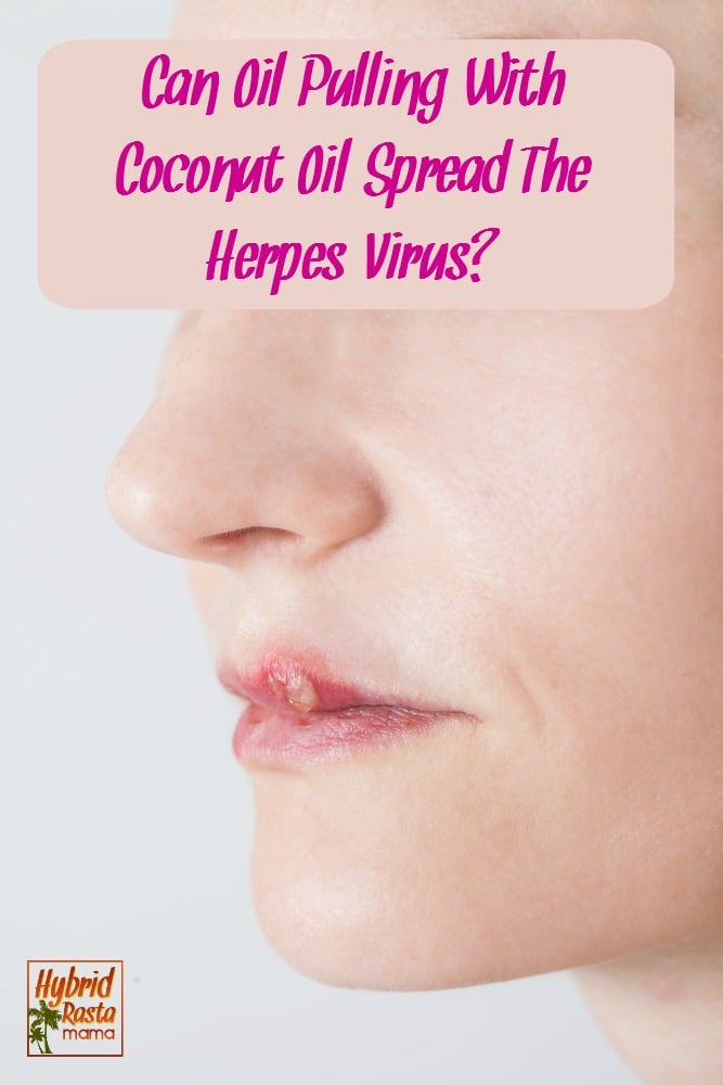 A woman with a cold sore (herpes) on her lip