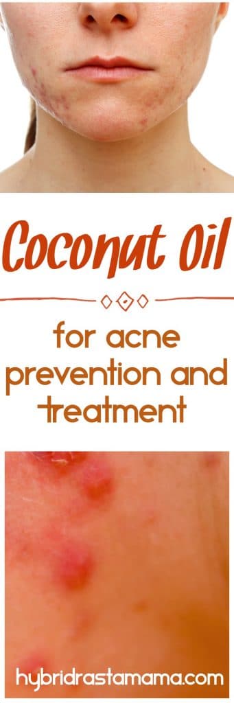 Did you know that you can use coconut oil for acne prevention and treatment? Learn how this powerful oil will kiss blemishes goodbye for good from HybridRastaMama.com.