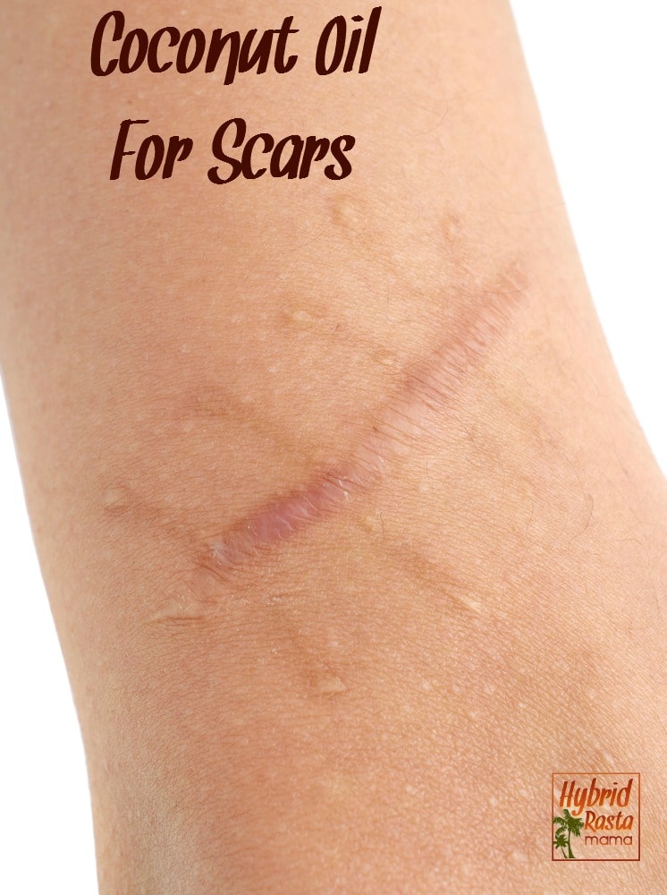 A woman using coconut oil for scarring on a large scar on her arm.