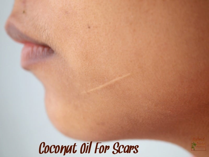 How To Prevent Scarring With Coconut Oil