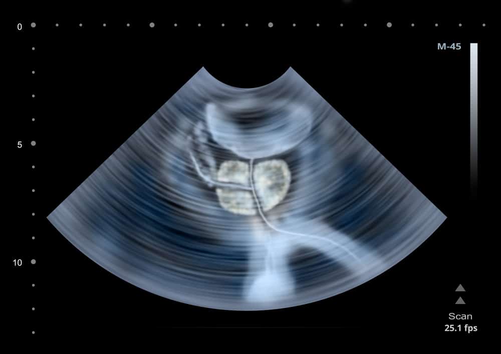 Ultrasound scan of human Prostate