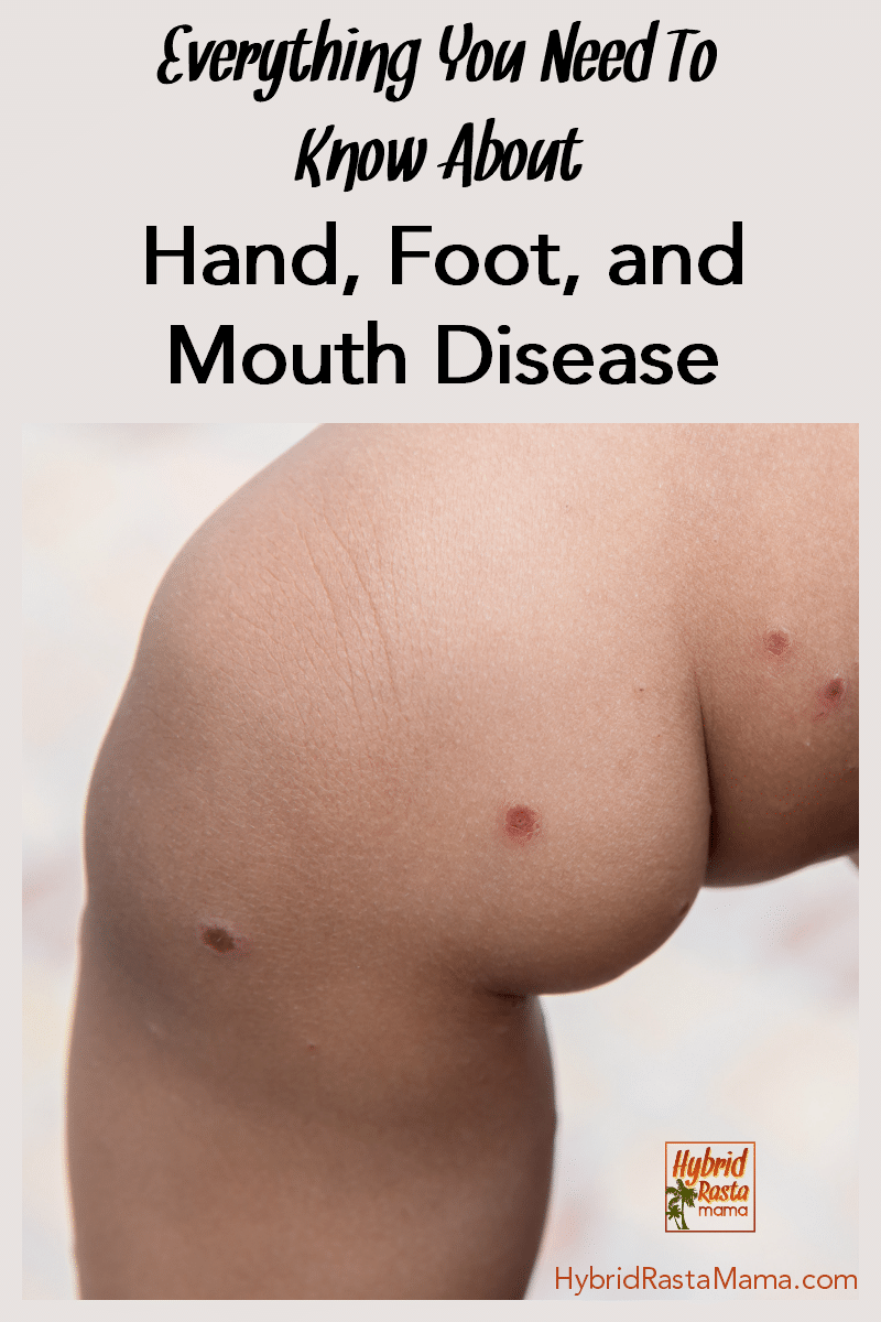 A child's leg with hand, foot, and mouth disease