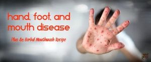 Grab this detailed information on treating hand, foot, and mouth disease naturally plus an herbal mouthwash recipe that is safe for all ages. From HybridRastaMama.com