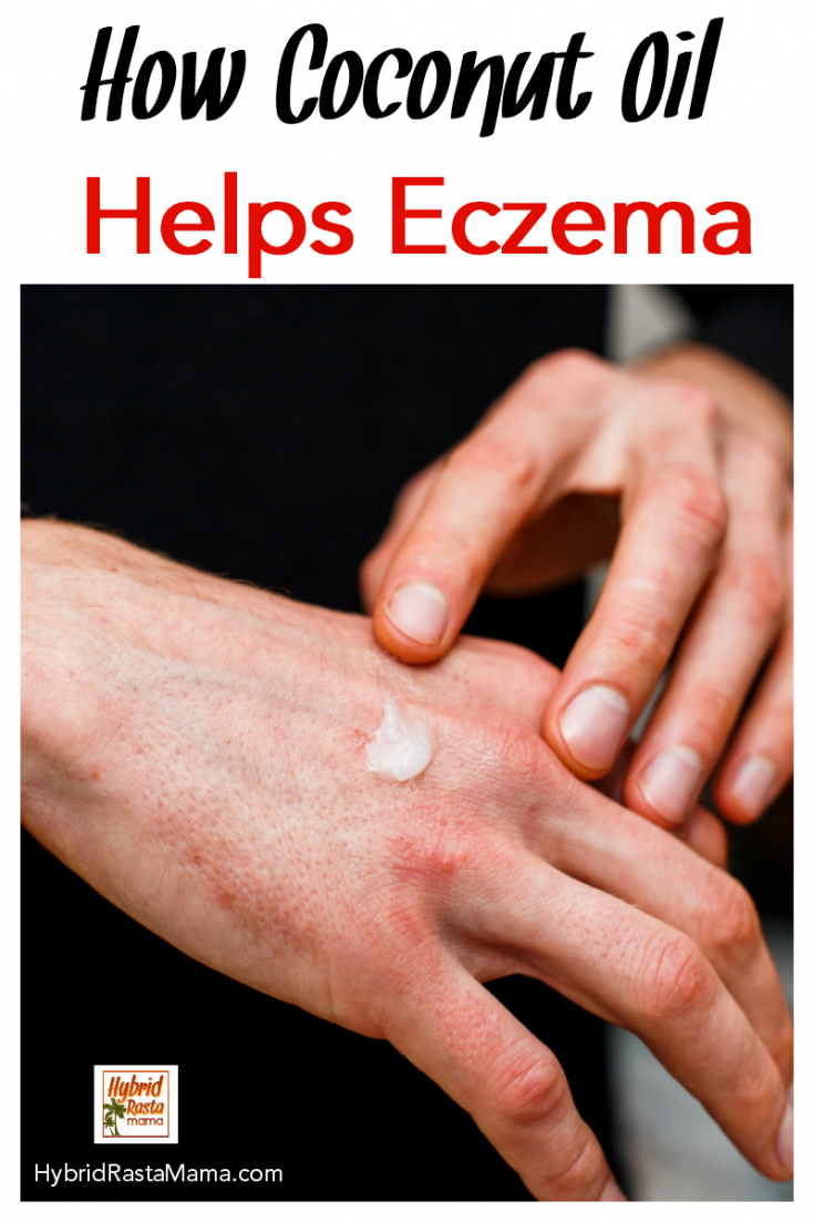 Coconut Oil for Eczema Hybrid Rasta Mama